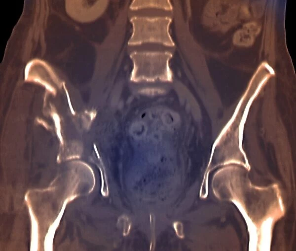 Fractured pelvis, CT scan C016  /  6584