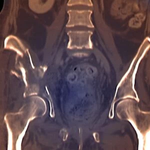 Fractured pelvis, CT scan C016 / 6584